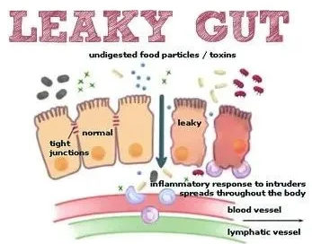 Healing Leaky Gut