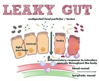 Healing Leaky Gut